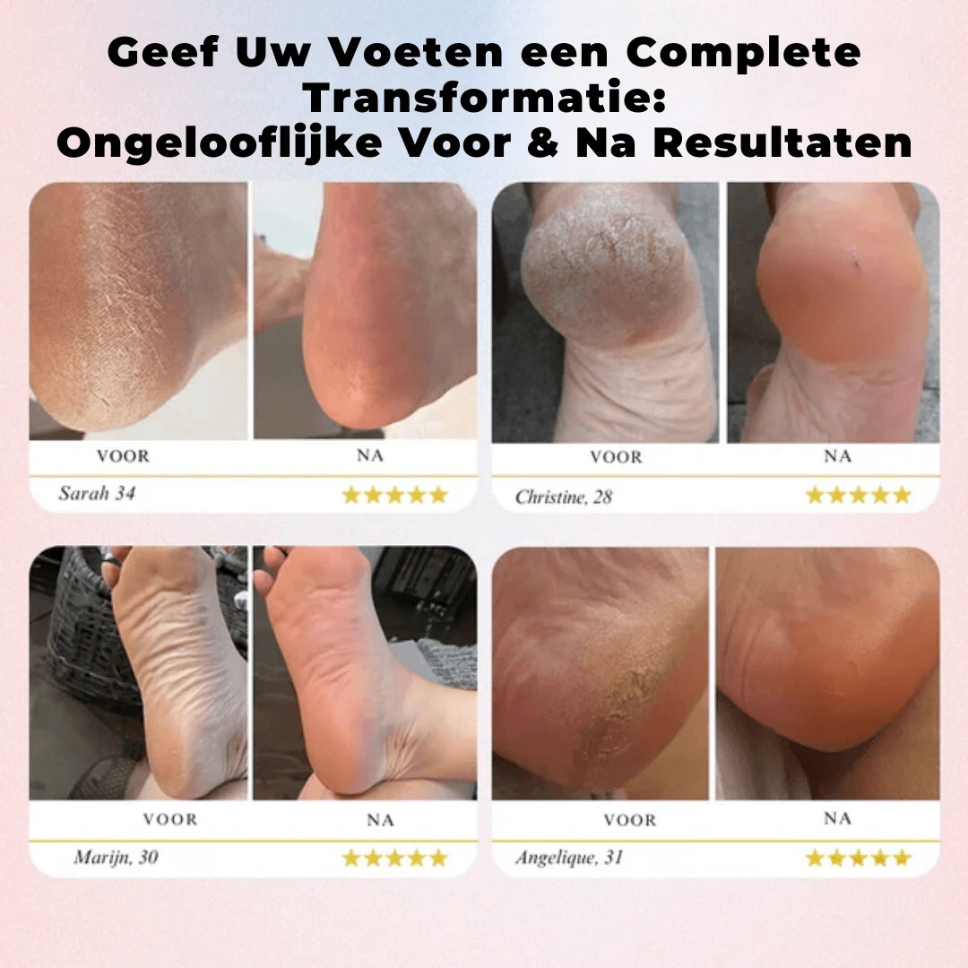 CareSole™ Elektrische voet eeltverwijderaar