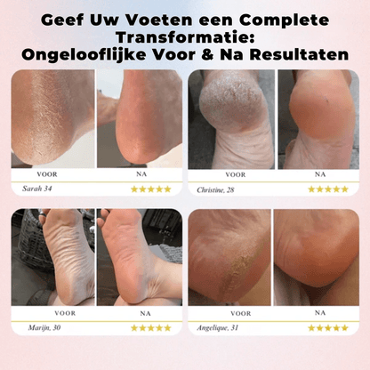 CareSole™ Elektrische voet eeltverwijderaar